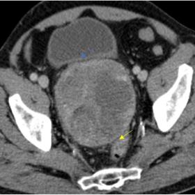 Axial (A) and sagittal (B) contrast-enhanced CT images reveal a retrovesical solid mass with heterogeneous enhancement, measu