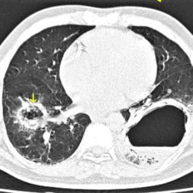 Axial non contrast CT image (lung window). Heterogeneous lesion with central ground glass opacity surrounded by consolidation