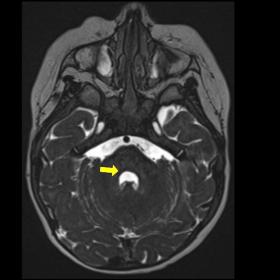 Absence of the nuclei of the VII cranial nerve, which configures the “horseshoe” shape of the 4th ventricle (yellow arrow