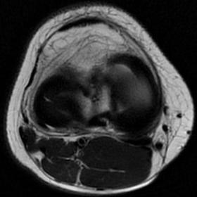 Non contrast axial MRI detected isolated radial tear of the midbody of lateral meniscus
