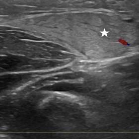 Ultrasound on transverse plane (a) and longitudinal plane (b) of the forearm shows a swollen brachioradialis muscle (star), w