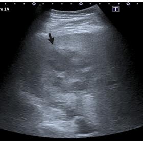 Cross-sectional ultrasound image through the right hepatic lobe showing a large hypoechoic mass with irregular peripheral hal
