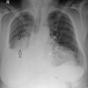Postero-anterior chest radiograph of the patient shows a well-defined relatively homogeneous opacity in the right mid zone (shown by arrow). There is blunting of the right costophrenic angle suggestive of pleural effusion. There is mild cardiomegaly. Prominent bronchovascular markings are seen in the rest of bilateral lung fields. Descending thoracic aorta shows a tortuous course