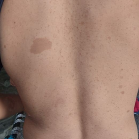 Clinical photograph of the patient’s back shows multiple café au lait spots and small skin neurofibromata