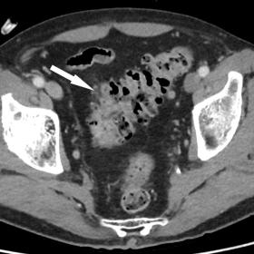 Baseline CT, performed the same day of the hospitalization, revealed mild diverticulitis (white arrow) with no complications