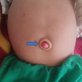 Clinical image of abdomen showing reddish polypoidal mass at umbilicus