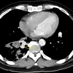 Contrast-enhanced CT scan of thorax axial (1a), coronal (1b) and sagittal (1c) images show intensely enhancing branching type