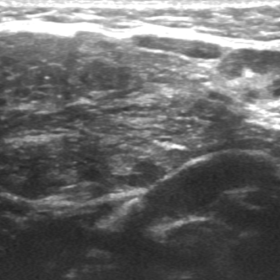 Ultrasound image of right submandibular gland showing increase in size and internal heterogeneity, with ill-defined borders, 