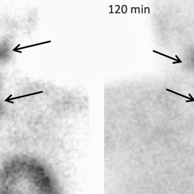 Early and delayed 99mTc-MIBI scintigraphy depicting four parathyroid glands exhibiting 99mTc-MIBI uptake