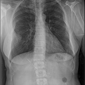Chest radiograph shows a triangular radiopacity in right mid & lower zone in the periphery with a broad base towards pleura. 