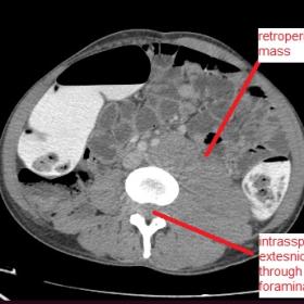On contrast enhanced CT scan, homogenously enhancing mass involving retroperitoneum with intraspinal extension. Lesion causes encasements of major abdominal vessels, giving rise to sandwich sign