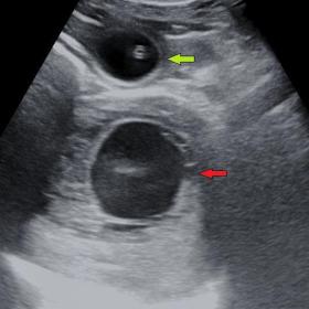 Grayscale ultrasound image showing solid cystic lesion (red arrow) in pelvis displacing the urinary bladder anteriorly. Green