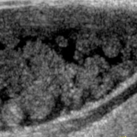 Ultrasound of the anterior neck shows a well-defined cystic lesion with fat-attenuating globules within. No evidence of vascularity was found in the colour Doppler study