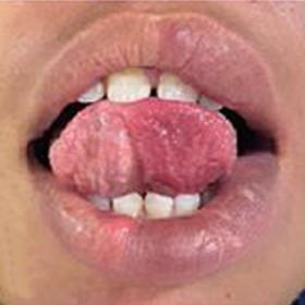 Hypertrophy of left half of tongue