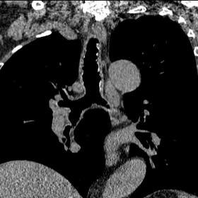 Coronal CT image in mediastinal window demonstrates scalloping of the tracheal wall, with multiple calcified and non-calcifie
