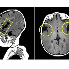 Sagittal and axial T1 weighted images show reduced operculization (yellow circle) with widening of the Sylvian fissures (yellow rectangle).