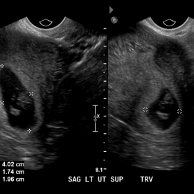 Left sagittal ultrasound image of the uterus.
