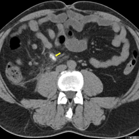 Non-contrast axial CT section shows hyperdense surgical clips in the appendiceal stump (arrow).