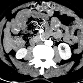 Axial CT angiographic image in the arterial phase demonstrates the submucosal ectatic vessel of 1.3mm diameter in jejunum. The vessel is a branch from ileocolic artery. There are no early opacification of the venous system.