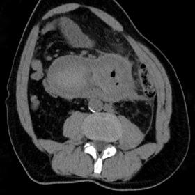 NECT (Non-contrast enhanced computed tomography) of retroperitoneal hematoma.