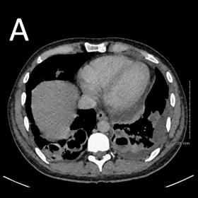 Initial axial contrast-enhanced CT image demonstrating extensive bilateral lower lobe consolidation and thick-walled cavitati