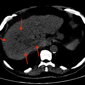 Axial CT image on the unenhanced phase. The irregular and inhomogeneous area of liver parenchyma was appreciable in segments 