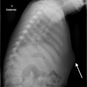 A 10-month-old boy, previously healthy, with 1-2 weeks complaint of a growing mass above the distal sternum. Chest X-ray, lat