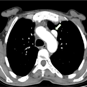Axial CT pulmonary angiogram at the level of the aortic arch displaying persistent left superior vena cava (PLSVC) ipsilatera