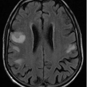 Axial T2 FLAIR (a) and DWI (b), accompanied by ADC mapping (c), reveal the presence of numerous lesions across cerebral hemis