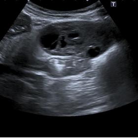 Ultrasound. Well-defined solid hypoechoic mass with cystic-appearing areas.