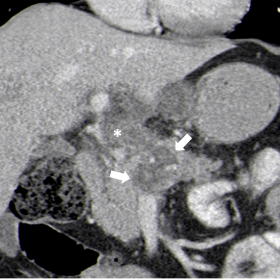 Coronal (1a) and axial (1b) images reveal a pancreatic isthmus pseudocyst (arrows) and extensive thrombosis of the portal vein (* in 1a) that extends to the spleno-mesenteric confluence (arrowhead in 1b).
