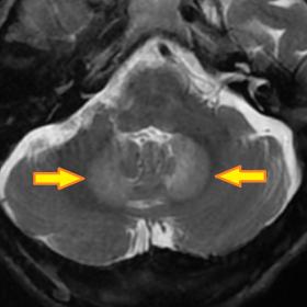 Axial T2 image of cerebellum shows bilateral symmetric abnormal hyperintensity (arrows) in dentate nuclei.