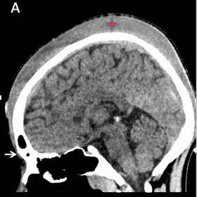 Sagittal, Axial, and Coronal 3D reformatted CT images (a, b, c) showing high-density subgaleal collection extending anteriorl