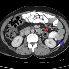 The red arrow shows the medialization of the descending colon. The blue arrow shows an empty left paracolic gutter with later