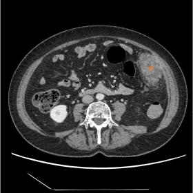 Abdomen and pelvis CT with iv contrast. Axial plane showing a 7 cm heterogeneous nodular mass (star) in the left lower quadra