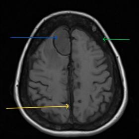 Axial T1 depicts a well-defined T1 hypointense mass lesion (blue arrow) with hemosiderin ring along interhemispheric falx. He