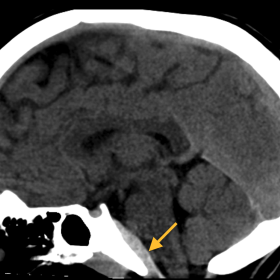 Non-contrast sagittal soft tissue window CT brain shows a retroclival epidural hematoma [REDH].