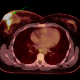 PET CT appearances are supportive of a metabolically hyperactive right breast malignancy with right axillary lymph nodal spre