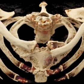 3D volume rendering derived from CT scan of the thorax. Description: Communitive extra-articular fracture at the sternal end of the left clavicle with anterior and slight superior displacement.