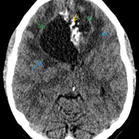 Non-contrast CT head (soft tissue window). Heterogeneous, predominantly cystic, intra-axial mass involving the bi-frontal region (green arrows), surrounding vasogenic oedema (blue arrow), and intralesional coarse calcifications (yellow arrow)