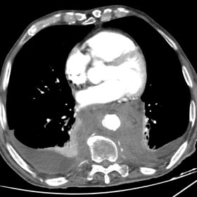 Post-contrast CT showing extensive circumferential soft tissue sheathing of the thoracic aorta (“coated aorta”). There is also bilateral pleural effusion.