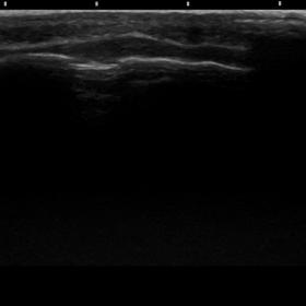 Ultrasound with the head elevated showing a small hypoechoic soft-tissue impression to the right of the sagittal fissure.