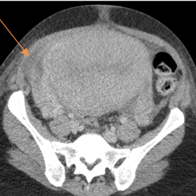 Pelvic contrast-enhanced CT, on the third post-operative day, in axial (a), coronal (b) and sagittal (c) planes, highlighting