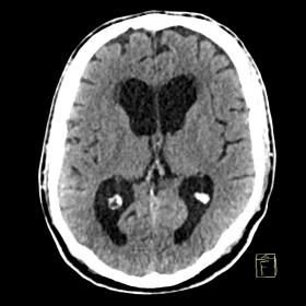 Non-contrast axial CT image taken one year before onset of current symptoms at the level of the lateral ventricle shows a mod