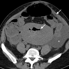Axial unenhanced CT. A significant amount of free fluid in the abdominal cavity (asterisk). A subtle amount of air in the uterus and the abdominal musculature, within a normal range following cesarean section (arrows).