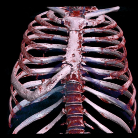 A volume rendering reconstruction that shows the dysplastic growth of the right seventh rib.