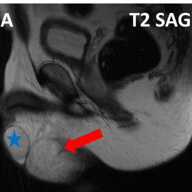 (a) to (d) – sagittal view; (e) to (h) – coronal view. The MRI revealed an oval intrascrotal mass (red arrow), inferior to the testicles and independent from them, with well-defined contours, measuring 75 x 55 x 30 mm. The mass is hyperintense on T2-weighted images. There are some thin septa (orange arrow). Right (blue star) and left (green star) testis.