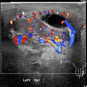 The colour Doppler ultrasonography reveals a hypertrophic left epididymis with marked hypervascularity, suggesting a typical 
