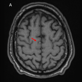 Small hyperintense extraaxial foci lesions on unenhanced T1-WI (A–C). From left to right: in extraaxial space (red arrows in A and B), intraventricular space (C). (D) Coronal T1-WI + Gad showing a mildly enhancing nodular lesion at left lateral ventricle temporal horn.