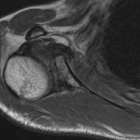 Axial MR proton density-weighted image of the right glenohumeral joint, showing glenoid flattening and its associated retrove